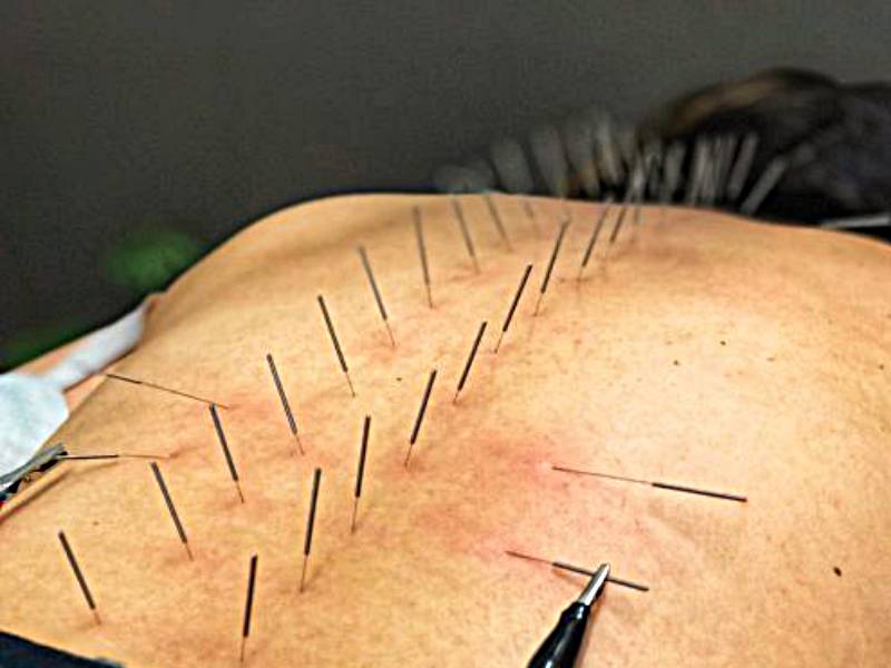 Acupuncture